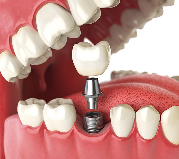 Mobile Will I Need a Bone Graft for Dental Implants