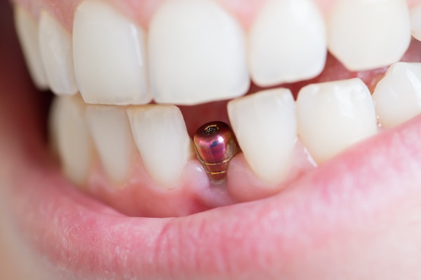Dental Implants Mobile, AL