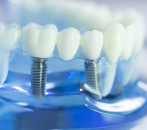 Mobile Dental Implants