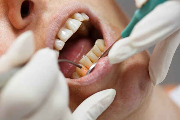 Can Laser Dentistry Be Used For Root Canals?