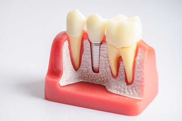 Root Canal Aftercare: Tips For A Smooth Recovery